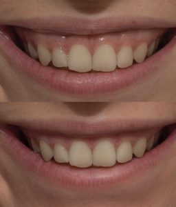 6.-gummy-smile.jpg